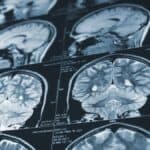 Proving Negligence in Brain Injury Cases